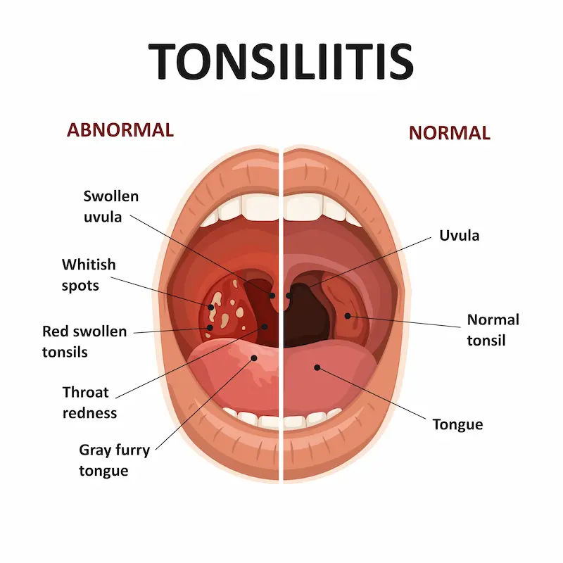 Home Remedies for Tonsillitis A Complete Guide